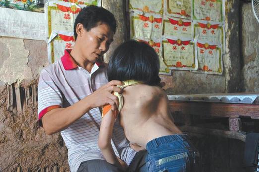 有嚴重脊椎畸形及胸腔隆突病的李文霞。