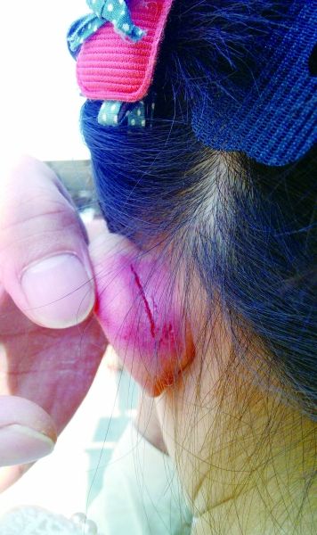 　　女童的耳朵被老師揪裂。圖片由女童家人提供