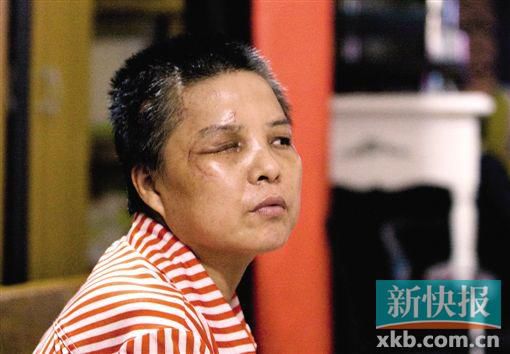 4月初,趙女士遭人搶劫并被打傷,現(xiàn)今右眼失明,頭部被縫100多針。記者 畢志毅/攝