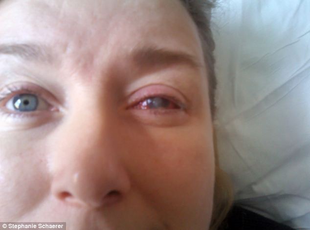 恐怖慎入！隱形眼鏡致英女子摘除眼球