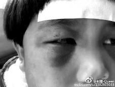 6月2日，網(wǎng)曝渭南市臨渭區(qū)一不滿5歲的女童遭奶奶毆打，眼圈青腫，引起網(wǎng)友關(guān)注，但孩子父母和爺爺均稱是摔倒導(dǎo)致。相關(guān)部門介入調(diào)查發(fā)現(xiàn)確為奶奶毆打所致，鑒于其身體原因已進(jìn)行批評(píng)教育。