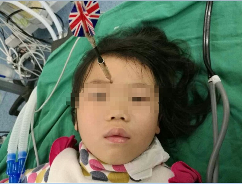 十多公分長(zhǎng)的飛鏢穩(wěn)穩(wěn)地 ” 定 ” 在了一名六歲半的女童額頭上，小青一家人凌晨從長(zhǎng)順趕到貴醫(yī)附院急診室時(shí)，看到如此慘烈的情況，接診醫(yī)生都嚇了一跳。詳細(xì)詢問下得知，原來(lái)是七歲的哥哥和六歲半的表妹在玩耍時(shí)，哥哥不慎將路邊撿來(lái)的真飛鏢扎到了妹妹的額頭上。