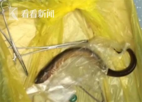 黃鱔從肛門鉆進(jìn)肚子 男子被送醫(yī)不愿多談事情經(jīng)過