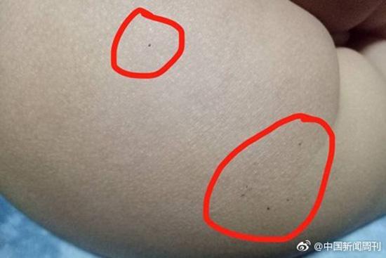 據(jù)多名紅黃藍(lán)(新天地分園)家長(zhǎng)反映，孩子腿部、屁股、腋下出現(xiàn)針眼。