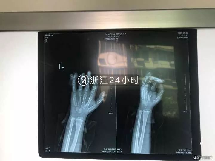 嚇哭！6歲男孩被夾斷手指 罪魁禍首竟是校服