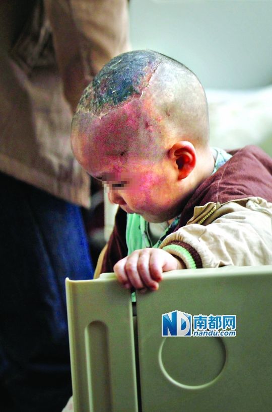 1月8日下午，小寶頭上和臉上都是傷痕。