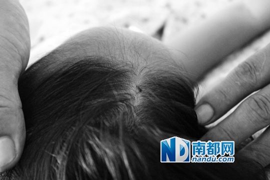 女童頭上被扎的針孔（圓圈處）。賈先生說，被扎不到三秒鐘，女兒就昏了。