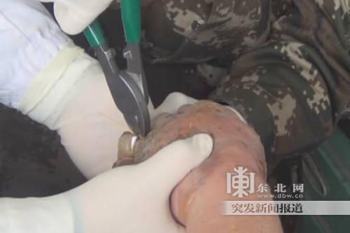正在拆除戒指。