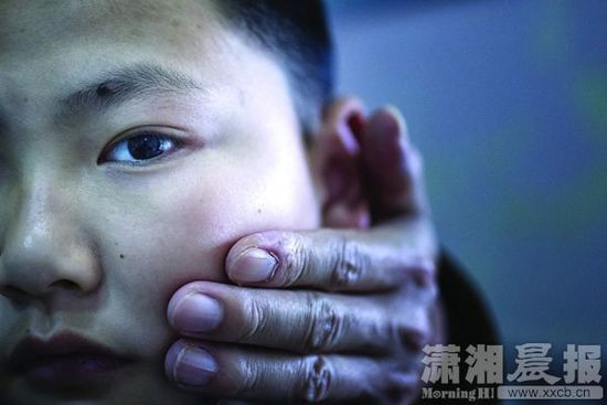 1月13日，小玨的父親心疼地摸著兒子的臉。
