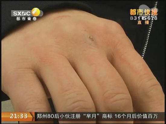 說到這足療拔罐，估計(jì)大伙都不陌生，但是想起4號(hào)晚上的拔罐的經(jīng)歷，呂先生現(xiàn)在想起來，還心有余悸。